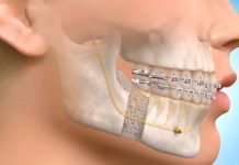 The Decision-Making Process Behind Complex Jaw Treatment Maxillofacial Surgeon