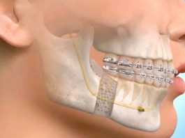The Decision-Making Process Behind Complex Jaw Treatment Maxillofacial Surgeon