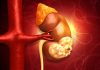 Kidney Cancer: Symptoms, Causes, Diagnosis, Treatment, and Prevention Kidney Cancer
