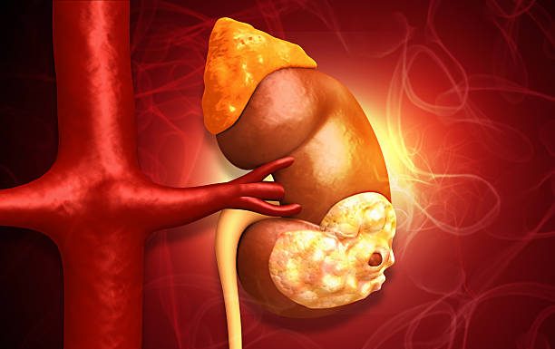 Kidney Cancer: Symptoms, Causes, Diagnosis, Treatment, and Prevention Kidney Cancer