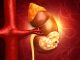 Kidney Cancer: Symptoms, Causes, Diagnosis, Treatment, and Prevention Kidney Cancer