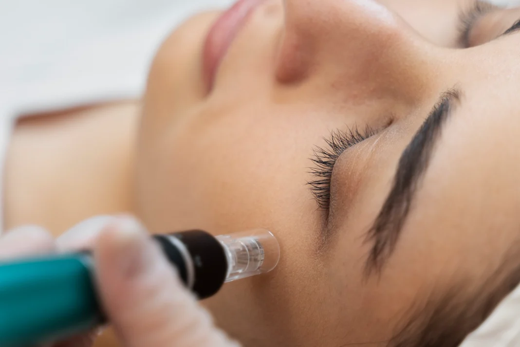 skin needling Perth