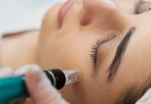 How Skin Needling in Perth Can Improve Acne Scars & Fine Lines skin needling Perth