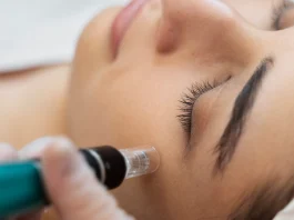 How Skin Needling in Perth Can Improve Acne Scars & Fine Lines skin needling Perth