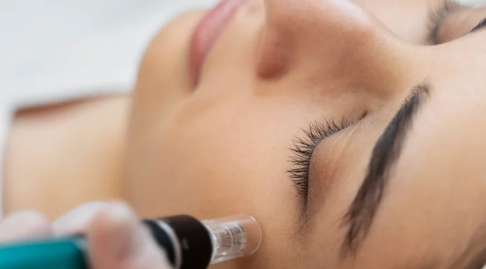 How Skin Needling in Perth Can Improve Acne Scars & Fine Lines skin needling Perth